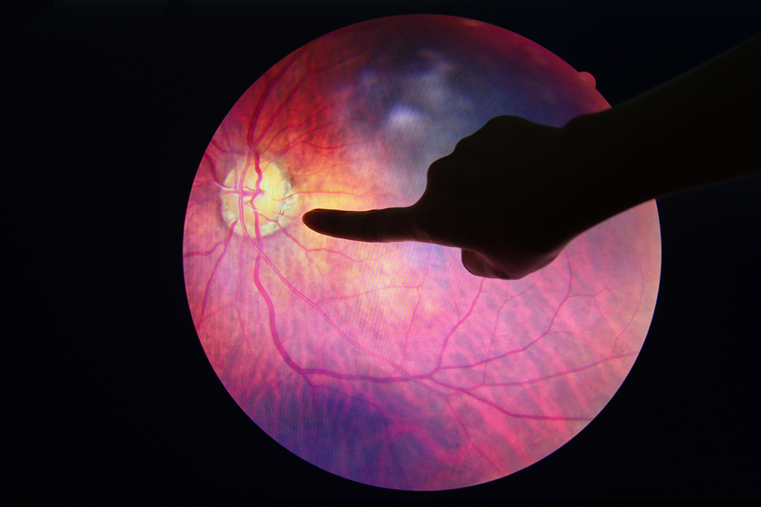 Diabetic Retinopathy an eyeball diagnosed with a diabetic problem