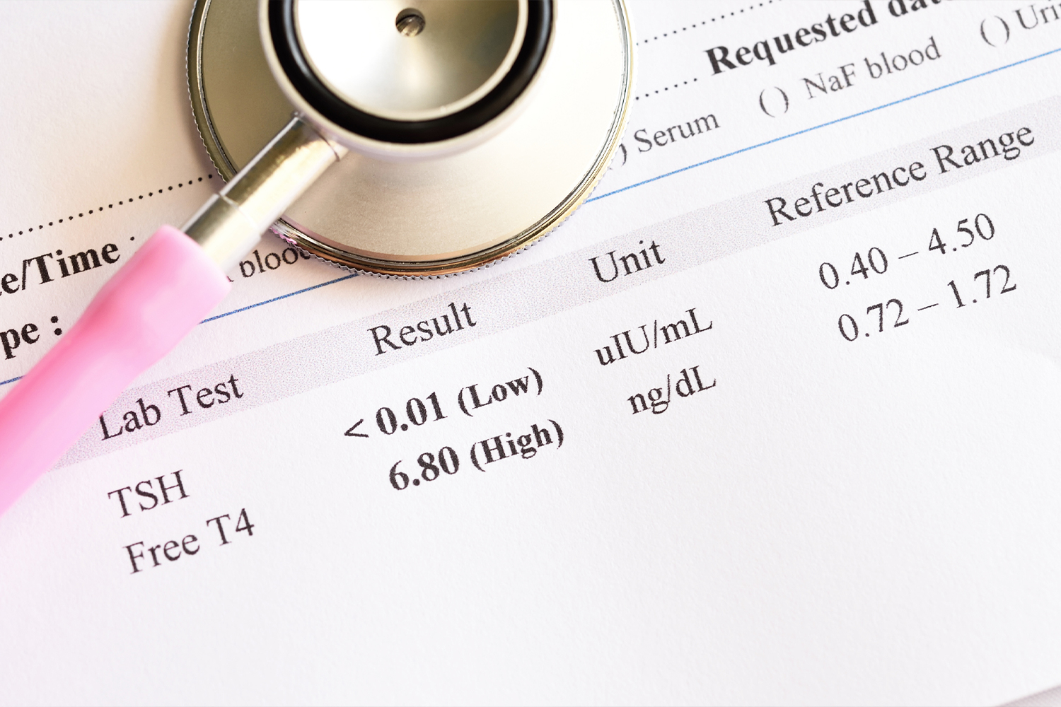 The Thyroid Is the Boss of You Abnormal thyroid hormone test result.