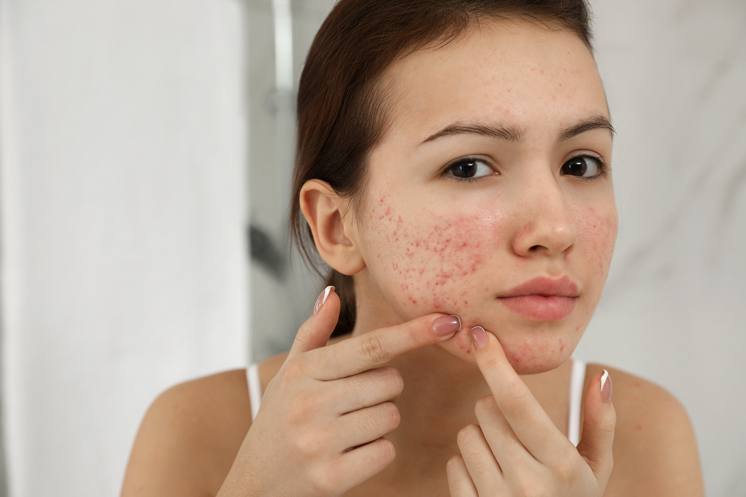 Acne: It’s More than Skin Deep a girl looking in the mirror while popping pimples