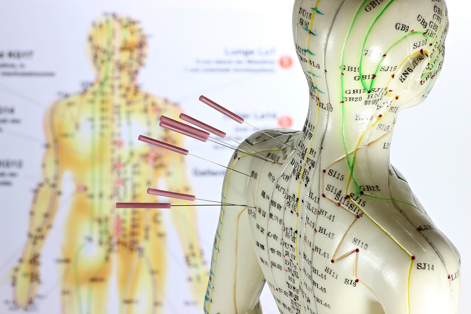 Female acupuncture model with needles in the shoulder.