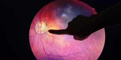 an eyeball diagnosed with a diabetic problem