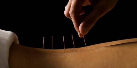 someone receiving acupuncture on their back in a dark room
