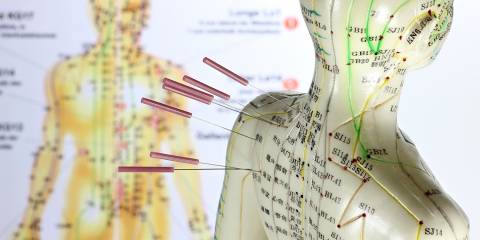 Female acupuncture model with needles in the shoulder.