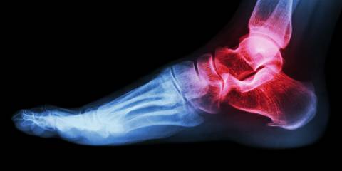Arthritis