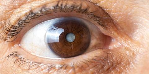 a close-up of an eye with a cloudy pupil