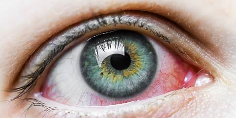 a beautiful eye marred by redness from conjunctivitis
