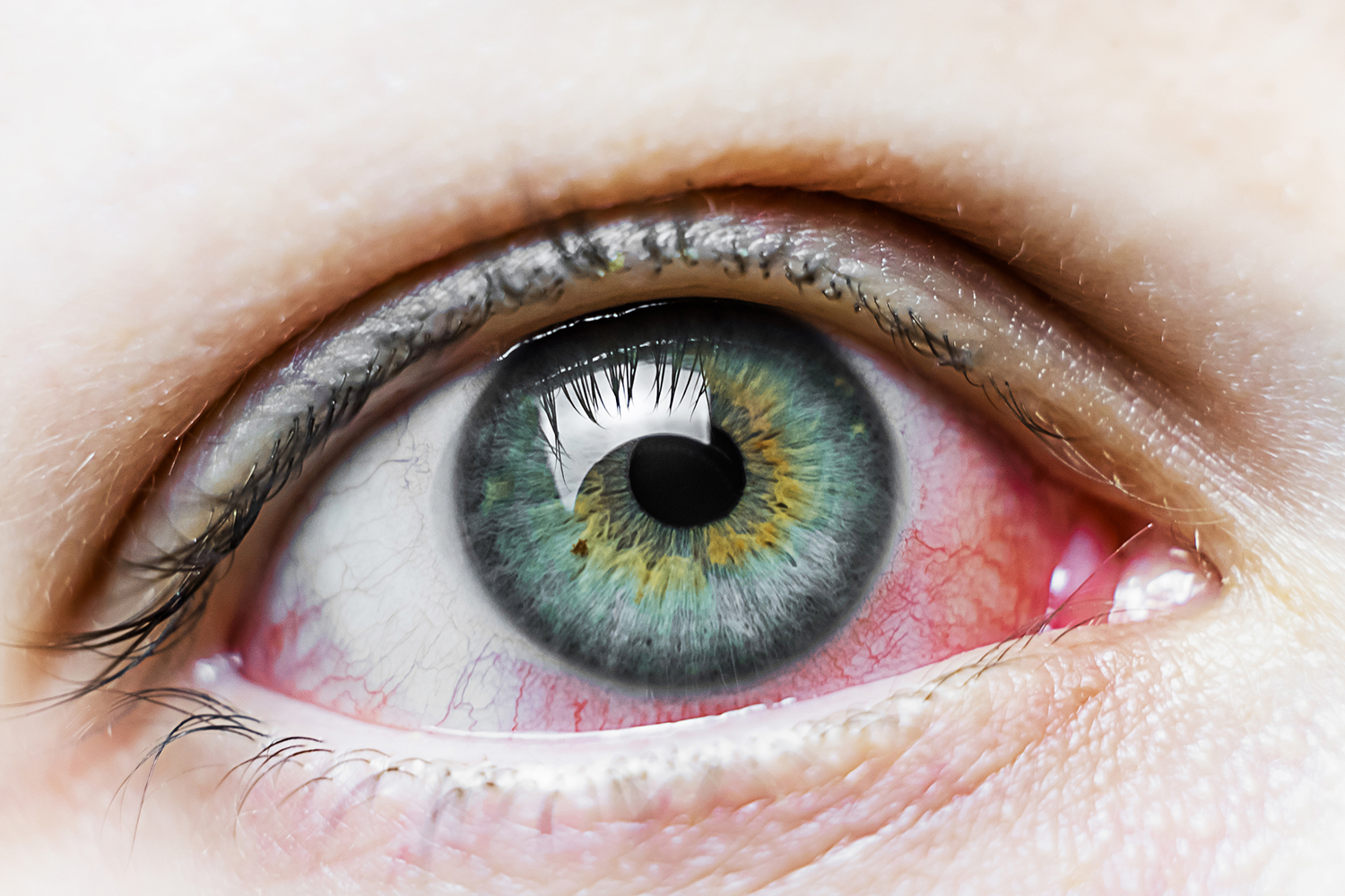 a beautiful eye marred by redness from conjunctivitis